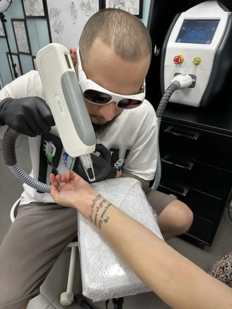 exemplu stergere tatuaj